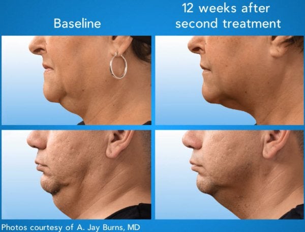 coolsculpting double chin fat removal lax tissue